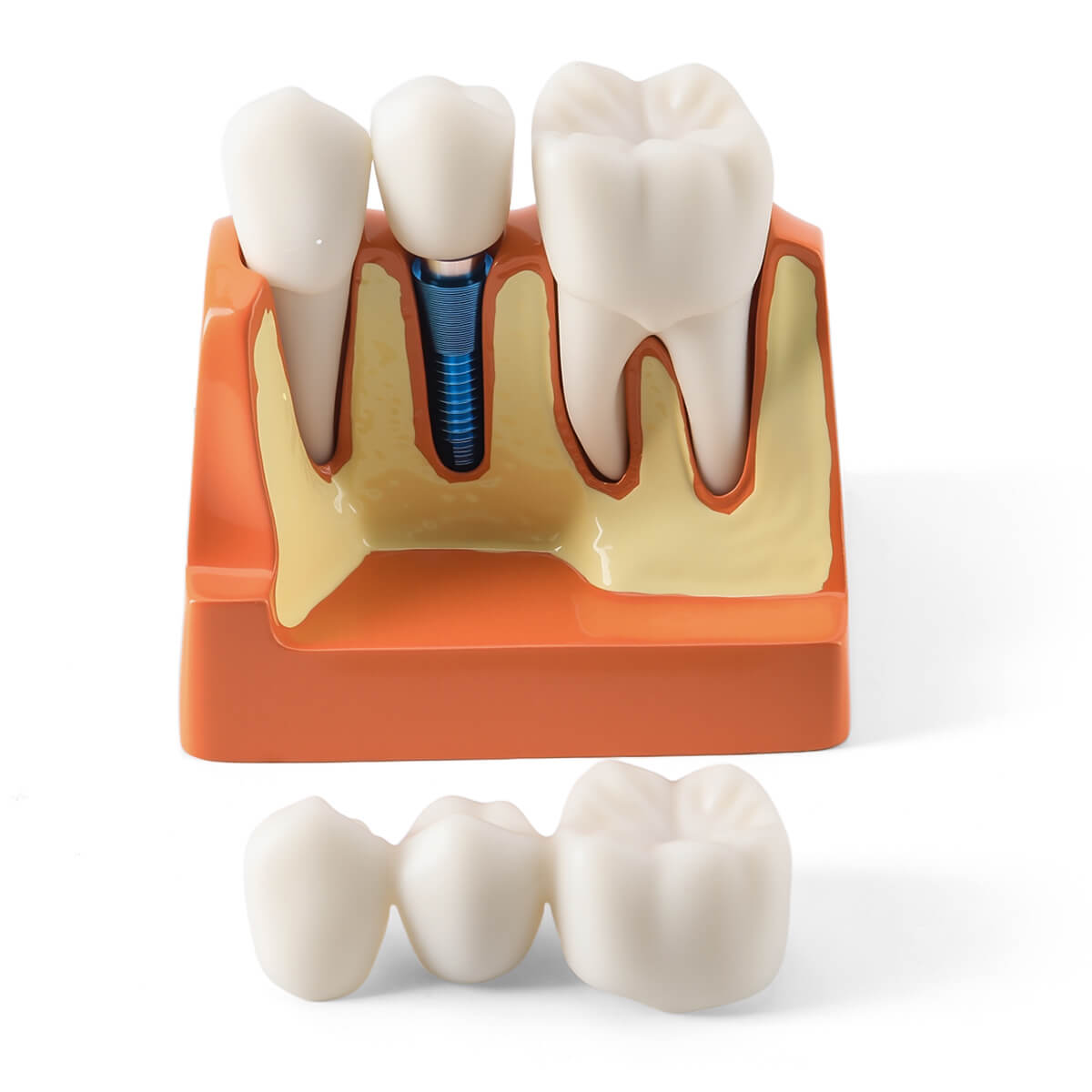 Dental 4 Times Implant Teeth Model Analysis Crown Bridge Demonstration Removable