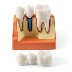 Dental 4 Times Implant Teeth Model Analysis Crown Bridge Demonstration Removable