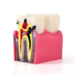 Dental Caries Tooth Model 6 Times Decay Teeth Comparative Study Model