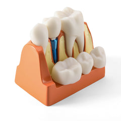 Dental 4 Times Implant Teeth Model Analysis Crown Bridge Demonstration Removable