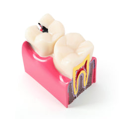 Dental Caries Tooth Model 6 Times Decay Teeth Comparative Study Model