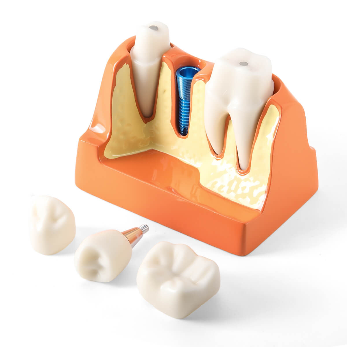 Dental 4 Times Implant Teeth Model Analysis Crown Bridge Demonstration Removable
