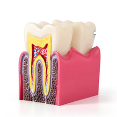 Dental Caries Tooth Model 6 Times Decay Teeth Comparative Study Model