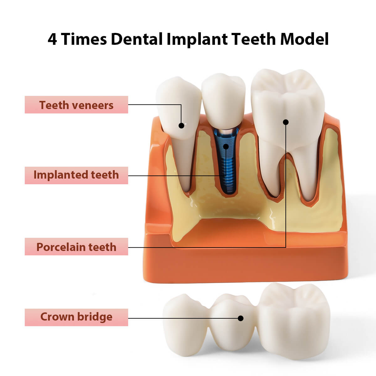 Dental 4 Times Implant Teeth Model Analysis Crown Bridge Demonstration Removable