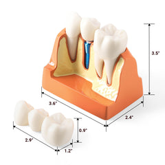 Dental 4 Times Implant Teeth Model Analysis Crown Bridge Demonstration Removable