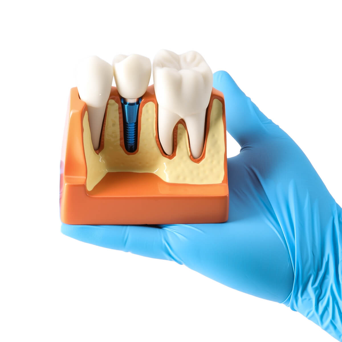 Dental 4 Times Implant Teeth Model Analysis Crown Bridge Demonstration Removable
