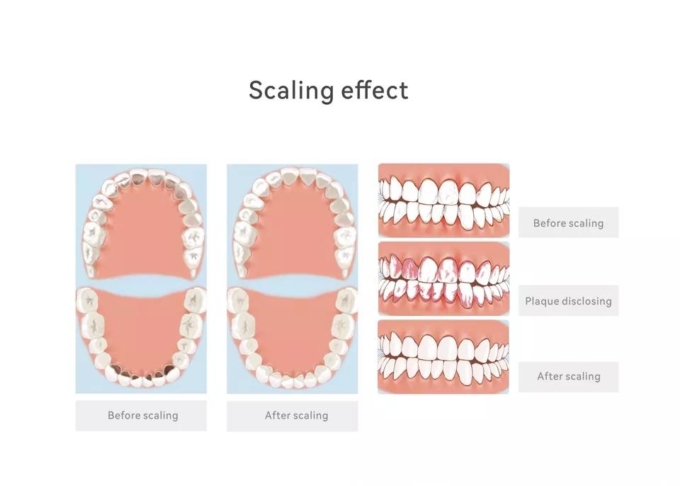 Ультразвуковой скалер и воздушная полировка Woodpecker Dental PT-A 2 в 1 Smart System