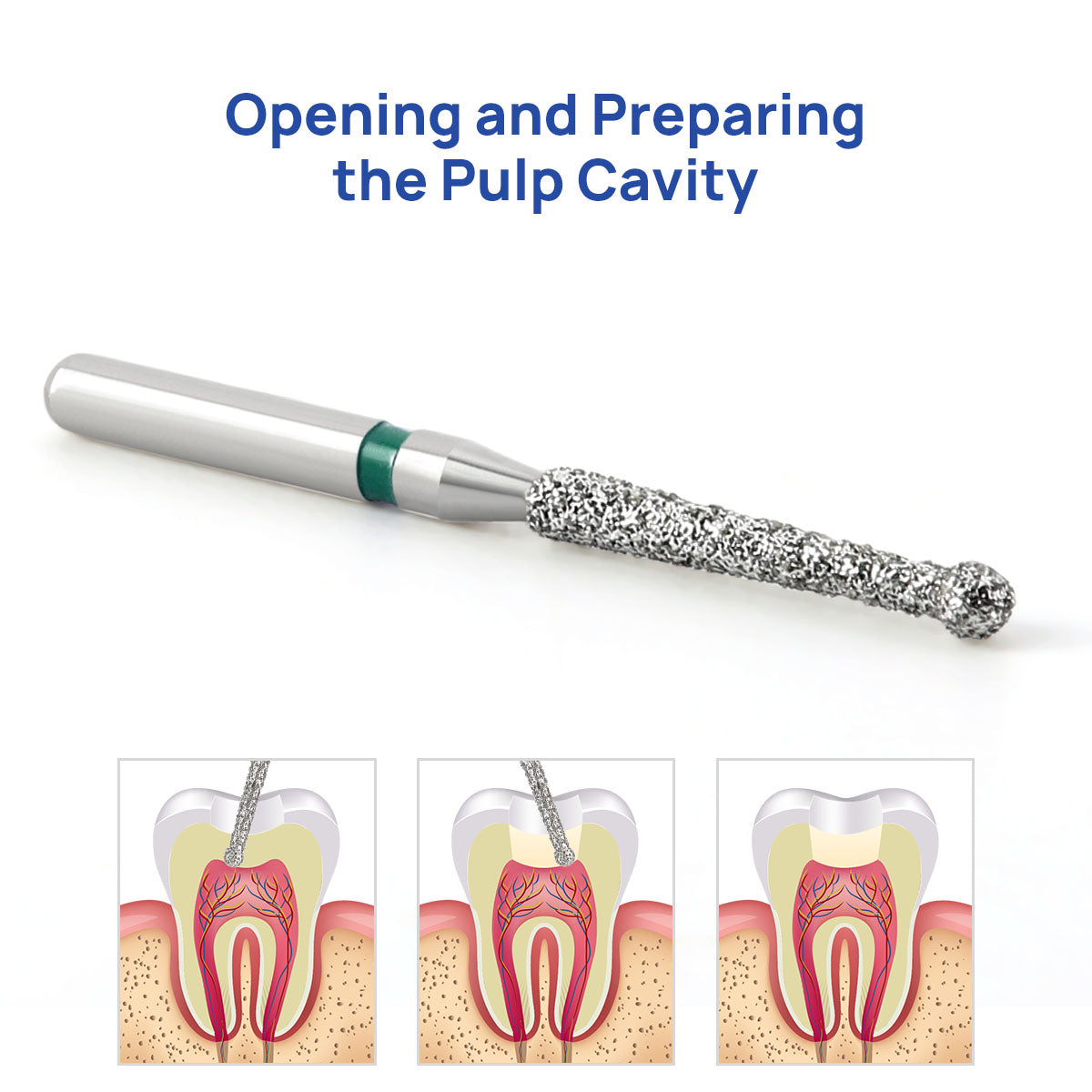 AZDENT Diamond FG Endo Burs Round For Opening and Preparing the Pulp Cavity 5pcs/Pack