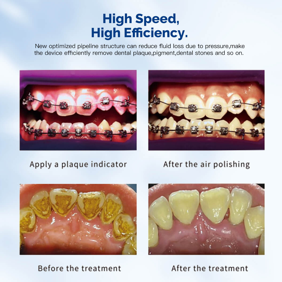 Raspador ultrasónico dental VRN-DQ40, pulidor de aire, sistema de terapia periodontal con chorro de arena, pieza de mano LED