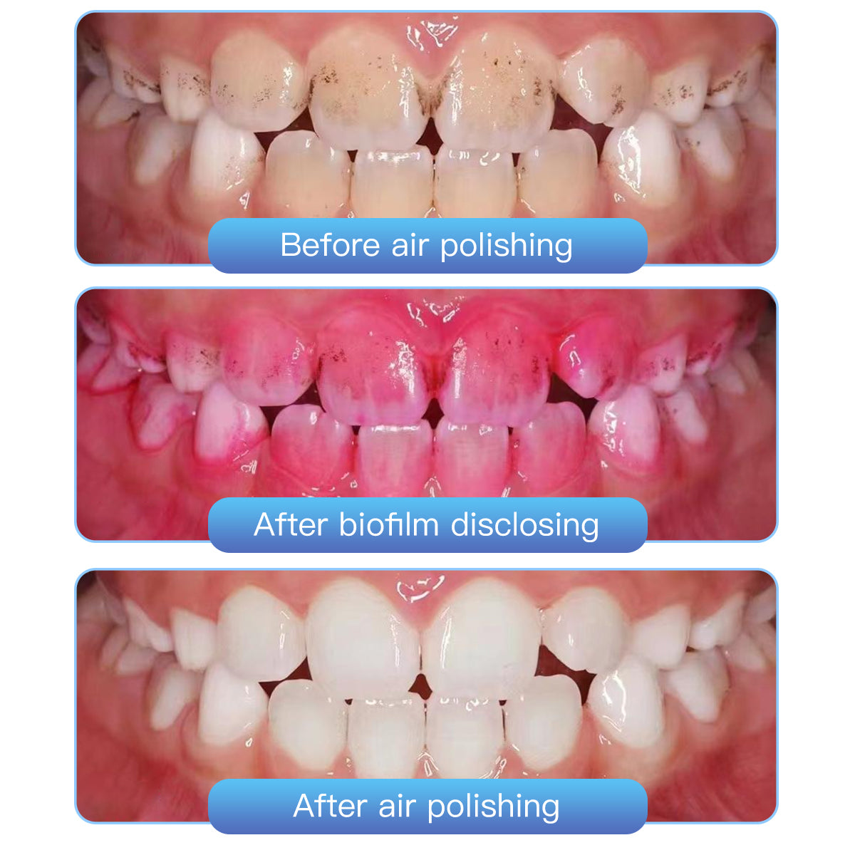 Стоматологический воздушный полировщик AZDENT Prophy Teeth Whitening A1S Съемный вращающийся на 360° наконечник с 4 отверстиями для быстрого соединения