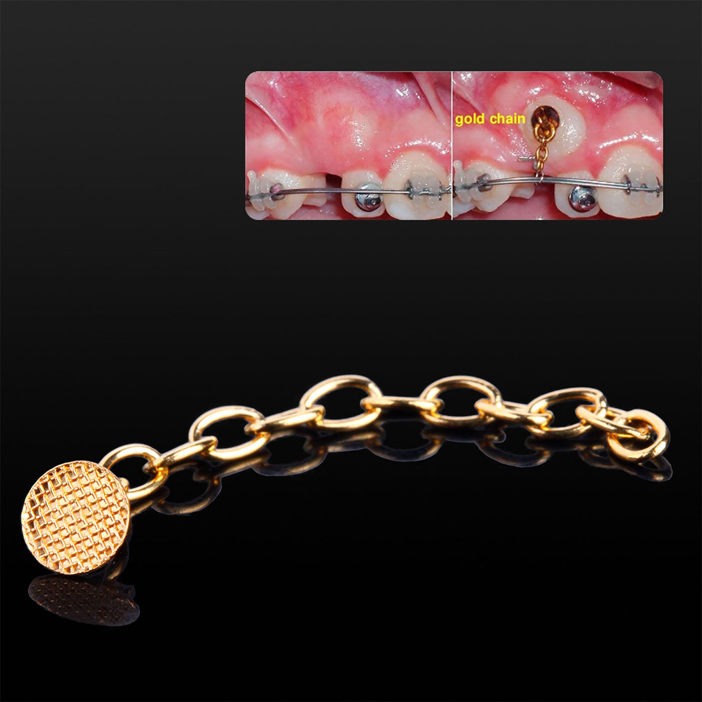 AZDENT Dental Traction Button Chain Golden Round 2/Bag