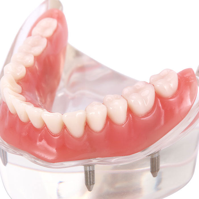 Dental Implant Teeth Model Demo Overdenture Restoration With 4 Implants Lower